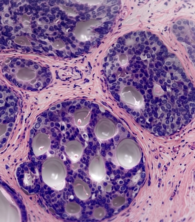 Carcinoma ductal · histología 3D